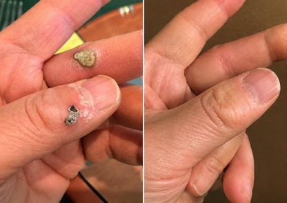 ✨Muwix®2-in-1 Microneedle & Hydrocolloid Patch?| Removes Raised Moles, Acne, Flat Warts & Skin Tags | Helps Improve Wrinkles, Scars & Blemishes | Invisible Patches for Face & Body